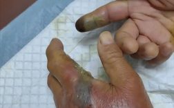 男子被毒蛇咬伤 忍痛抓又被来一口 专家：保命方法必须记住！