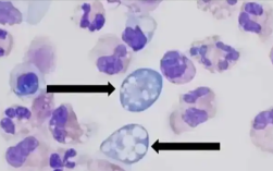 印度“食脑虫”感染病例数激增：主要通过口鼻腔等途径进入人体！