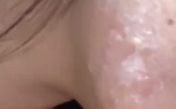 女子回应唱K感染病毒8年反复发作：嘴巴离话筒太近所致!