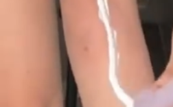 姐妹俩用了同款面霜双双汞中毒送医 医生提醒!