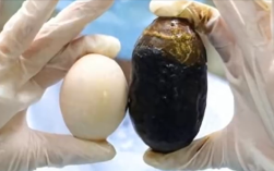 70岁老太体内暗藏125克胆结石：胆囊差点被撑爆！