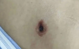 深圳一女子被恙螨咬后高烧3天：出现感染性休克!