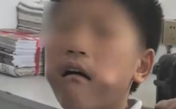 男孩把三角尺塞进嘴中被卡 消防赶到后将尺子夹碎取出！