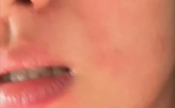 演员王楚然求助荨麻疹治疗方法：痒到崩溃 网友大呼感同身受！